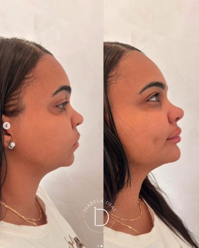 resultado contorno facial