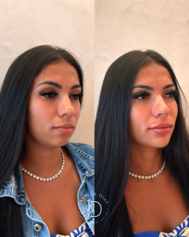resultado harmonização facial