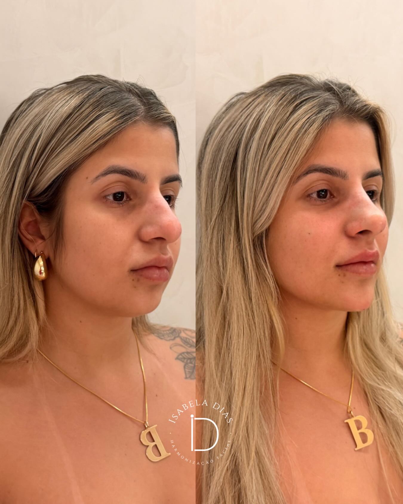 resultado harmonização facial